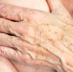 告別老年斑困擾！抗氧化與防曬的關鍵策略