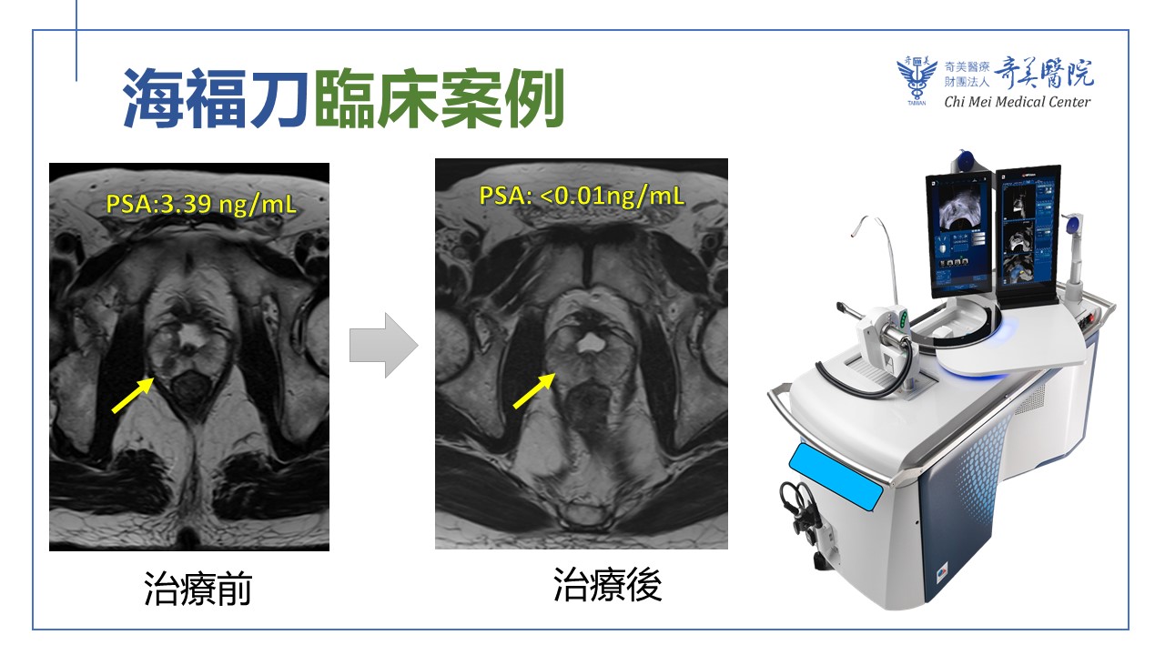 奇美醫院海福刀無創手術 結合即時影像 精準摧毀癌細胞